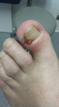 Injury to the toe on the foot.
