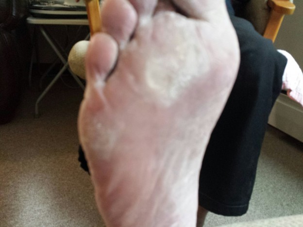 Locking Toes Gallery Of Foot Diseases / Abnormalities | Foot Care Specialist ...
