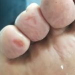 Left side of the foot with irritated sores on all toes.