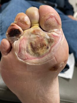 Loss of sensation in the foot